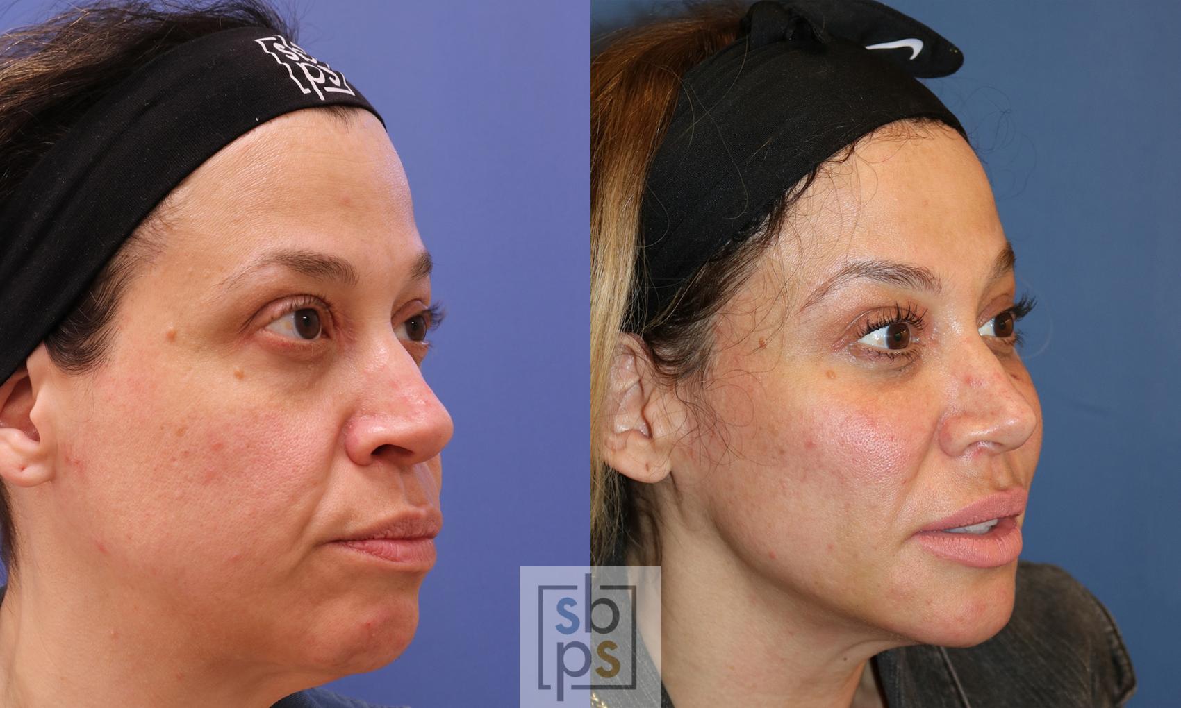 Before & After Fat Injection Case 476 Right Oblique View in Torrance & Los Angeles, CA, CA