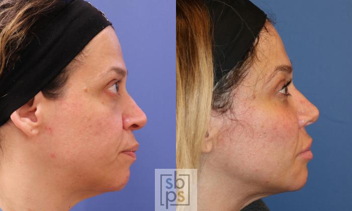 Before & After Fat Injection Case 476 Right Side View in Torrance, CA