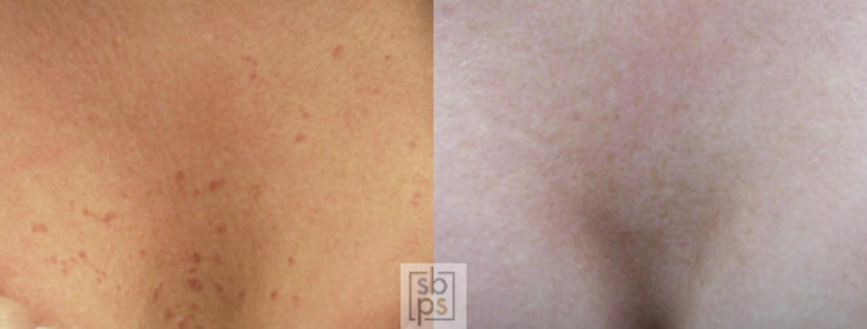 Before & After Laser Hyperpigmentation Treatment Case 19 View #1 View in Torrance, CA