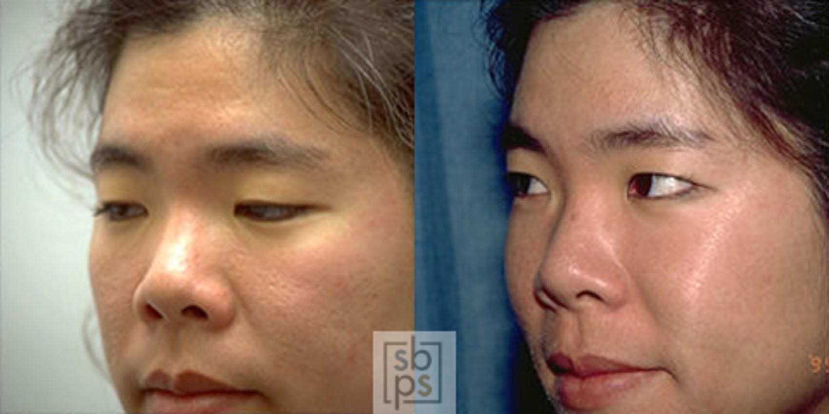 Before & After Laser Hyperpigmentation Treatment Case 2 View #1 View in Torrance, CA