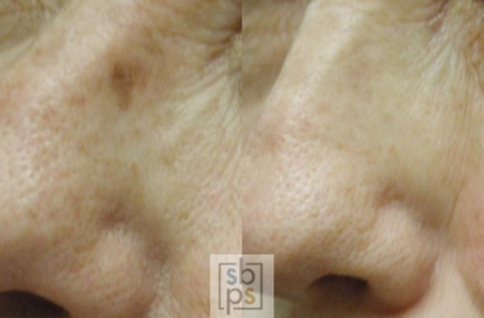 Before & After Laser Hyperpigmentation Treatment Case 20 View #1 View in Torrance, CA