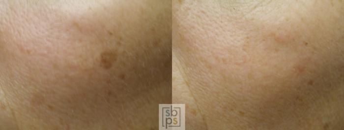 Before & After Laser Hyperpigmentation Treatment Case 21 View #1 View in Torrance, CA