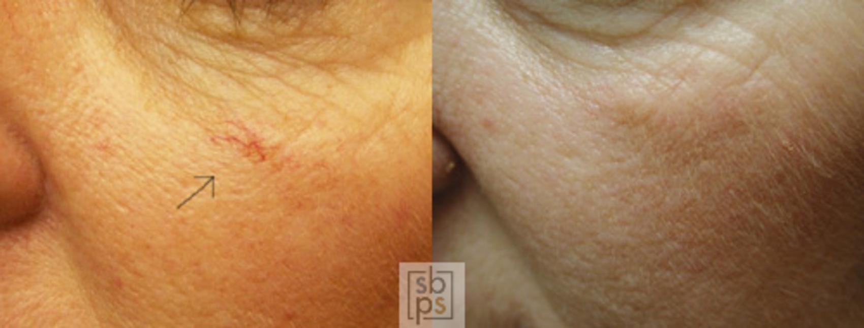 Before & After Laser Hyperpigmentation Treatment Case 22 View #1 View in Torrance, CA
