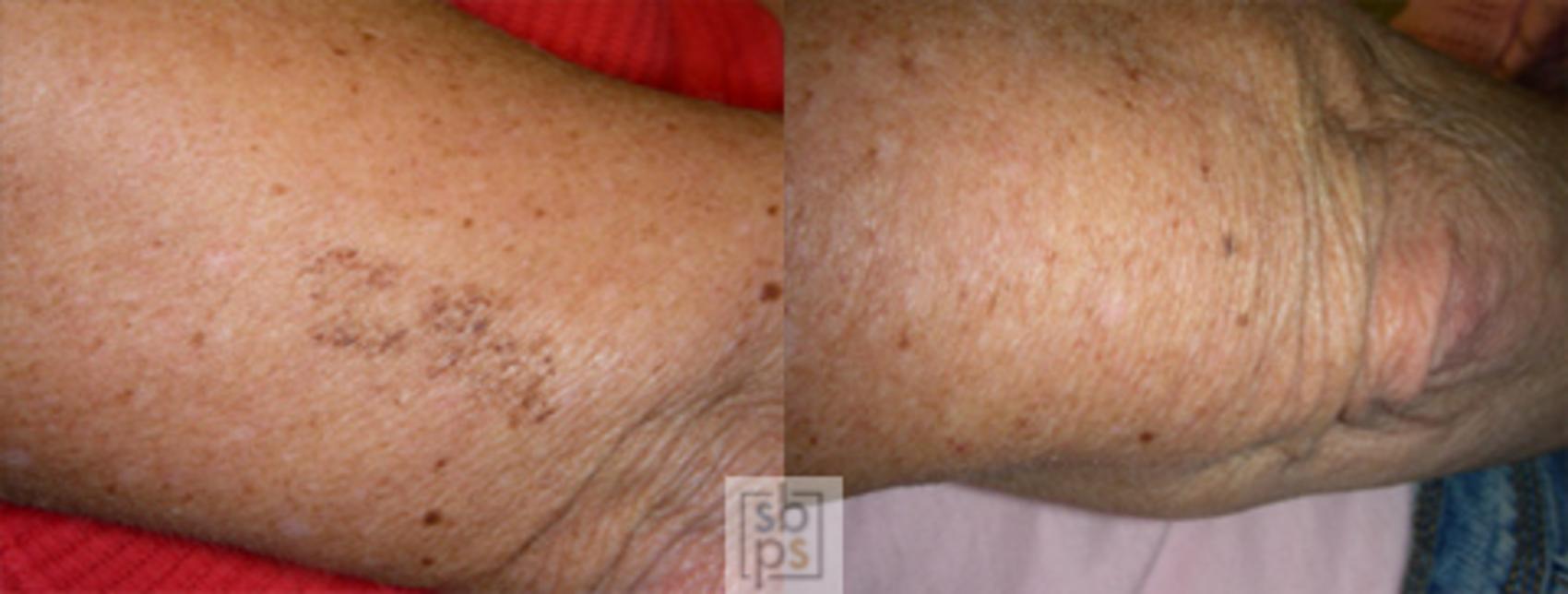 Before & After Laser Hyperpigmentation Treatment Case 26 View #1 View in Torrance, CA