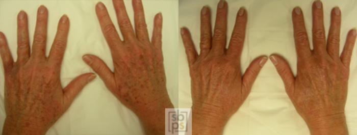 Before & After Laser Hyperpigmentation Treatment Case 27 View #1 View in Torrance, CA