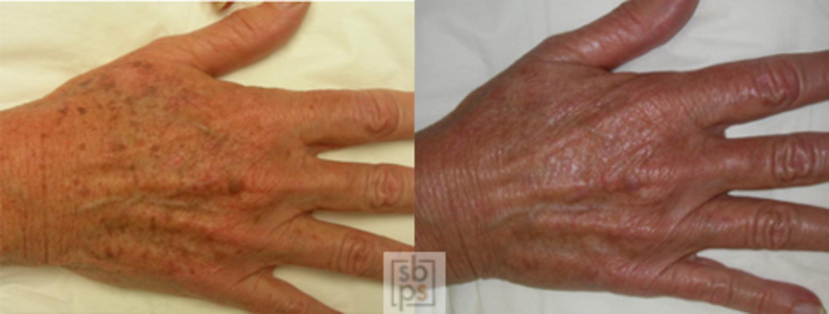 Before & After Laser Hyperpigmentation Treatment Case 27 View #2 View in Torrance & Los Angeles, CA, CA