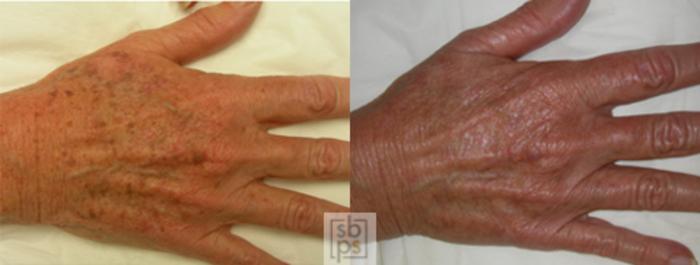 Before & After Laser Hyperpigmentation Treatment Case 27 View #2 View in Torrance, CA
