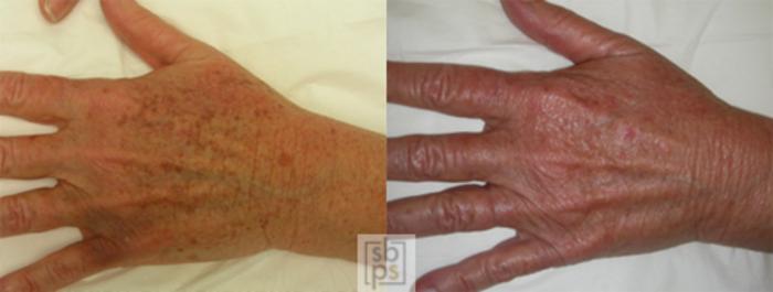 Before & After Laser Hyperpigmentation Treatment Case 27 View #3 View in Torrance, CA