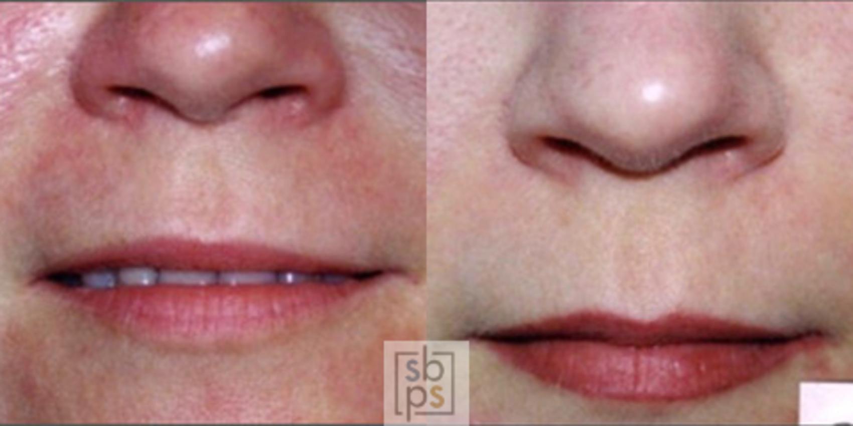 Before & After Laser Hyperpigmentation Treatment Case 4 View #1 View in Torrance, CA