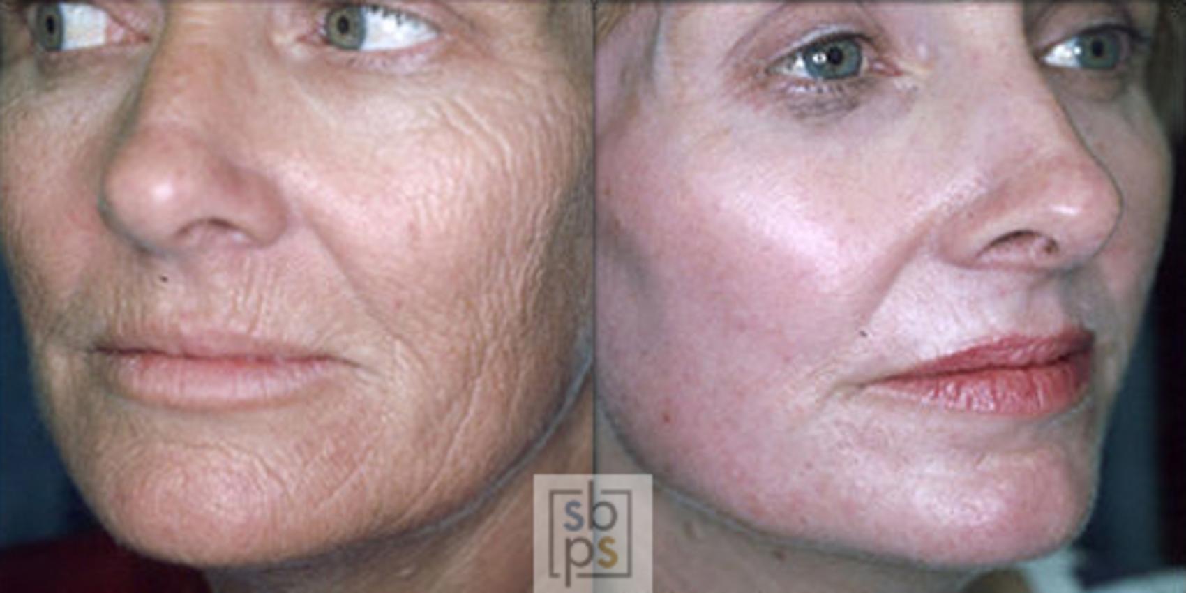 Before & After Laser Resurfacing Case 10 View #1 View in Torrance, CA