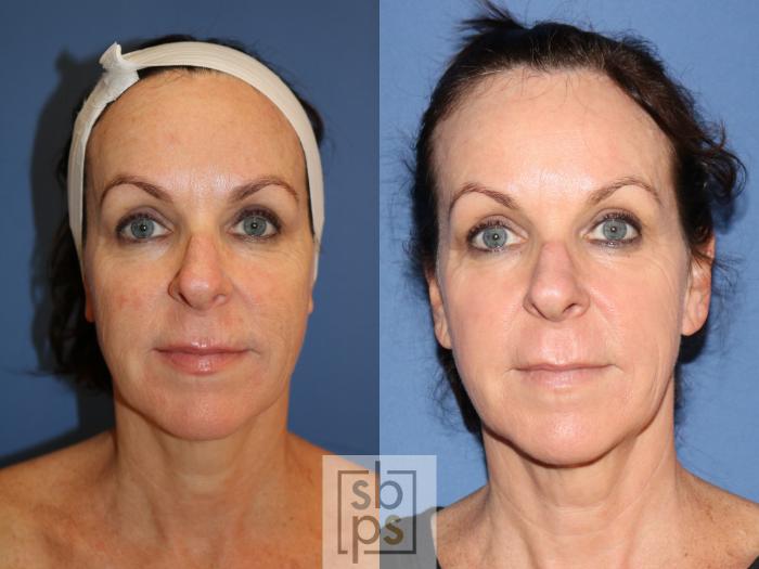 Before & After Laser Resurfacing Case 267 View #1 View in Torrance, CA