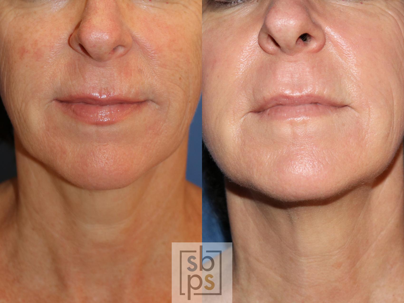 Before & After Laser Resurfacing Case 267 View #2 View in Torrance & Los Angeles, CA, CA