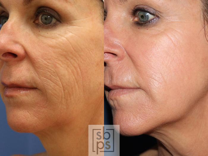 Before & After Laser Resurfacing Case 267 View #3 View in Torrance, CA