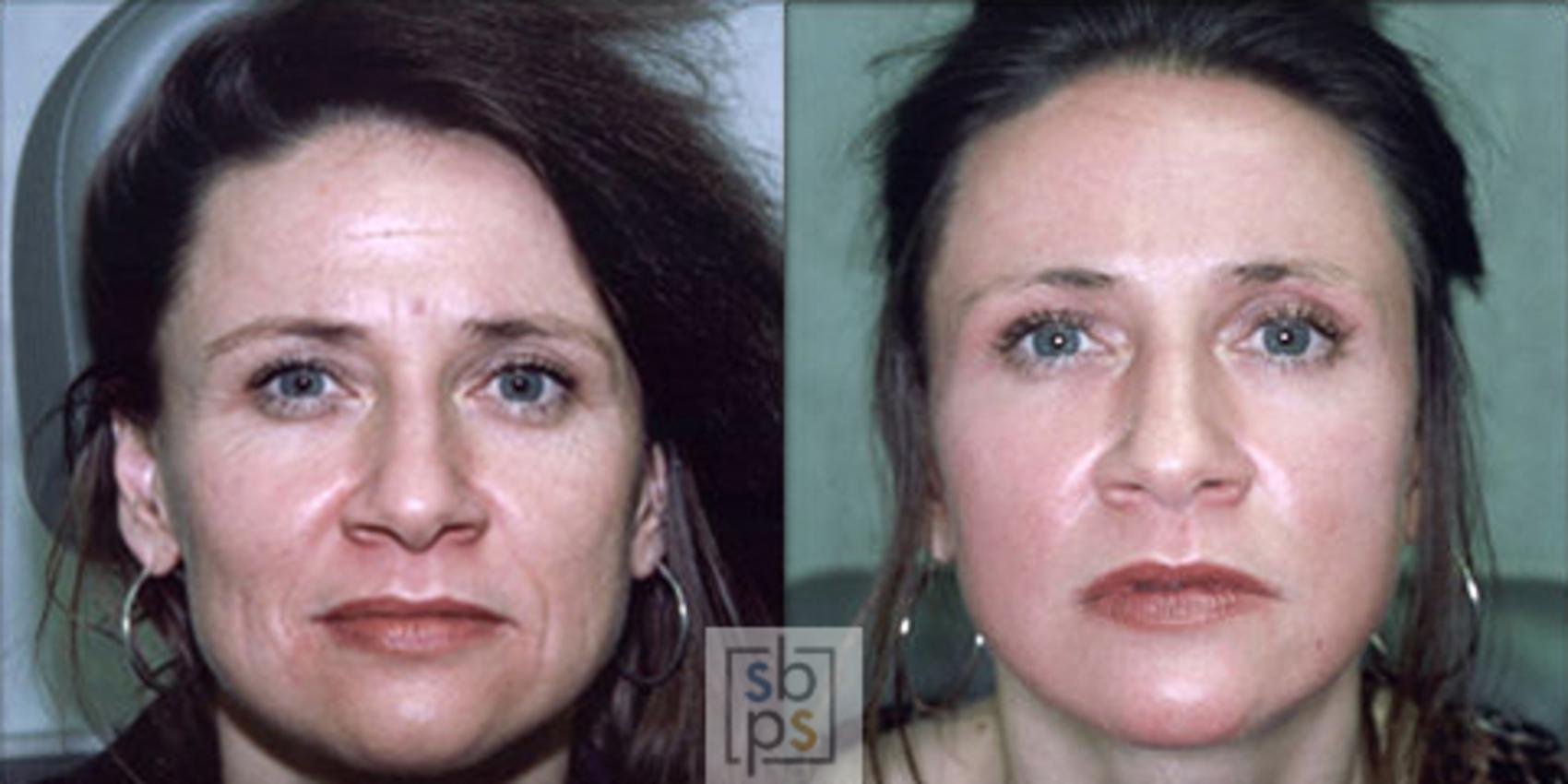 Before & After Laser Resurfacing Case 3 View #1 View in Torrance, CA