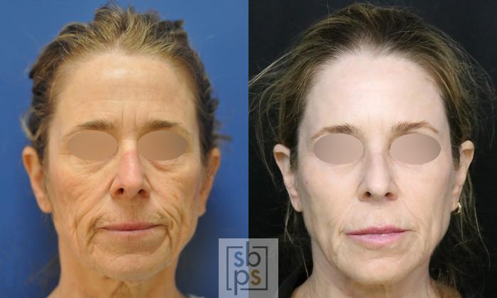 Before & After Laser Resurfacing Case 407 Front View in Torrance, CA