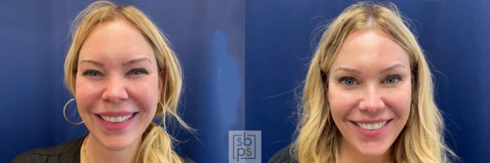 Before & After Laser Hyperpigmentation Treatment Case 525 Front View in Torrance, CA