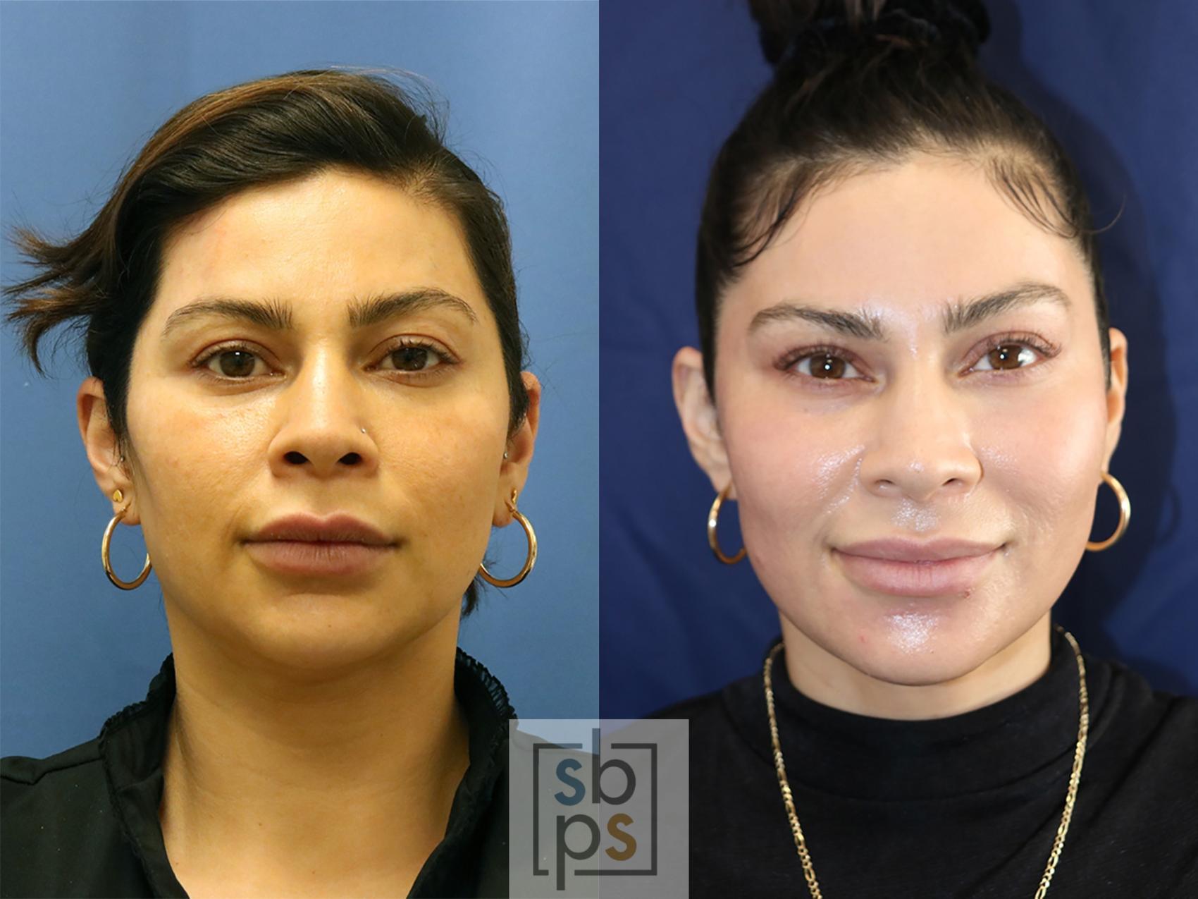 Before & After Laser Resurfacing Case 556 Front View in Torrance, CA