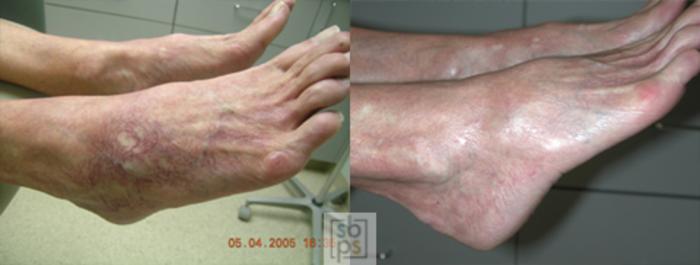 Before & After Laser Vein Removal Case 28 View #1 View in Torrance, CA