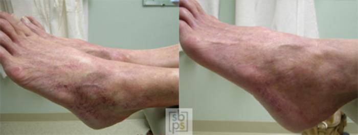 Before & After Laser Vein Removal Case 28 View #2 View in Torrance, CA