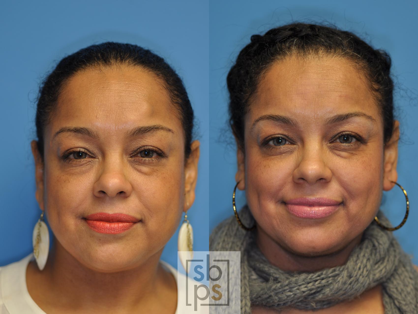 Lipoma & Mole Removal Before & After Photo Gallery