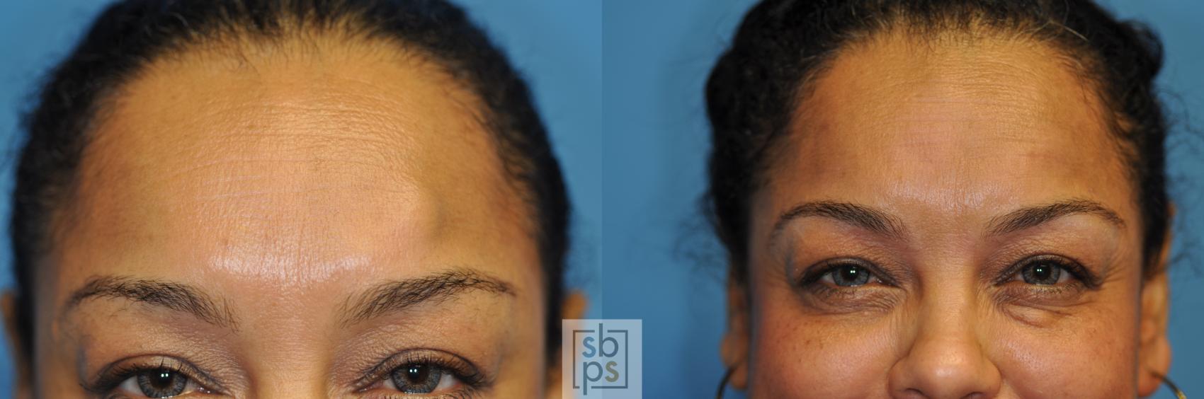 Before & After Lipoma & Mole Removal Case 119 View #2 View in Torrance & Los Angeles, CA, CA