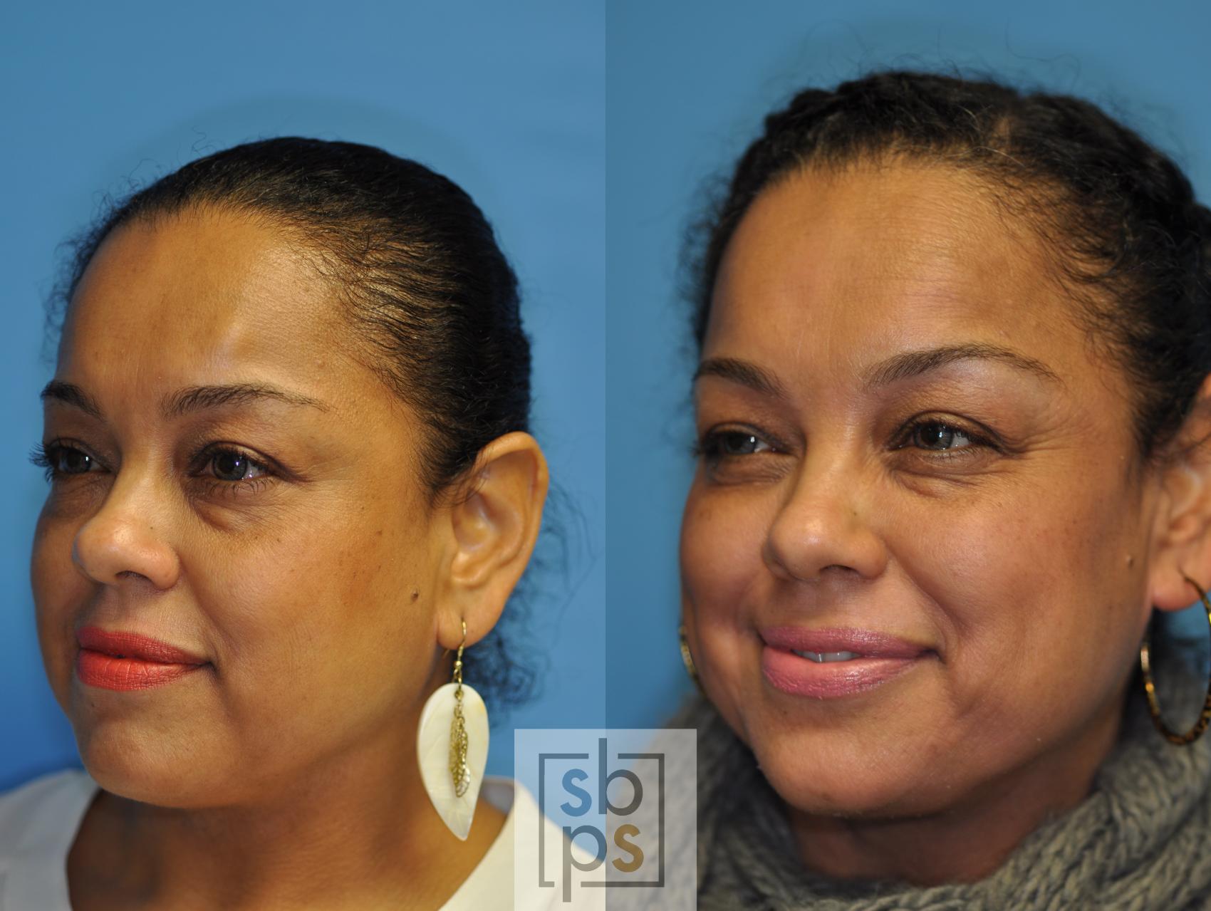 Before & After Lipoma & Mole Removal Case 119 View #3 View in Torrance & Los Angeles, CA, CA