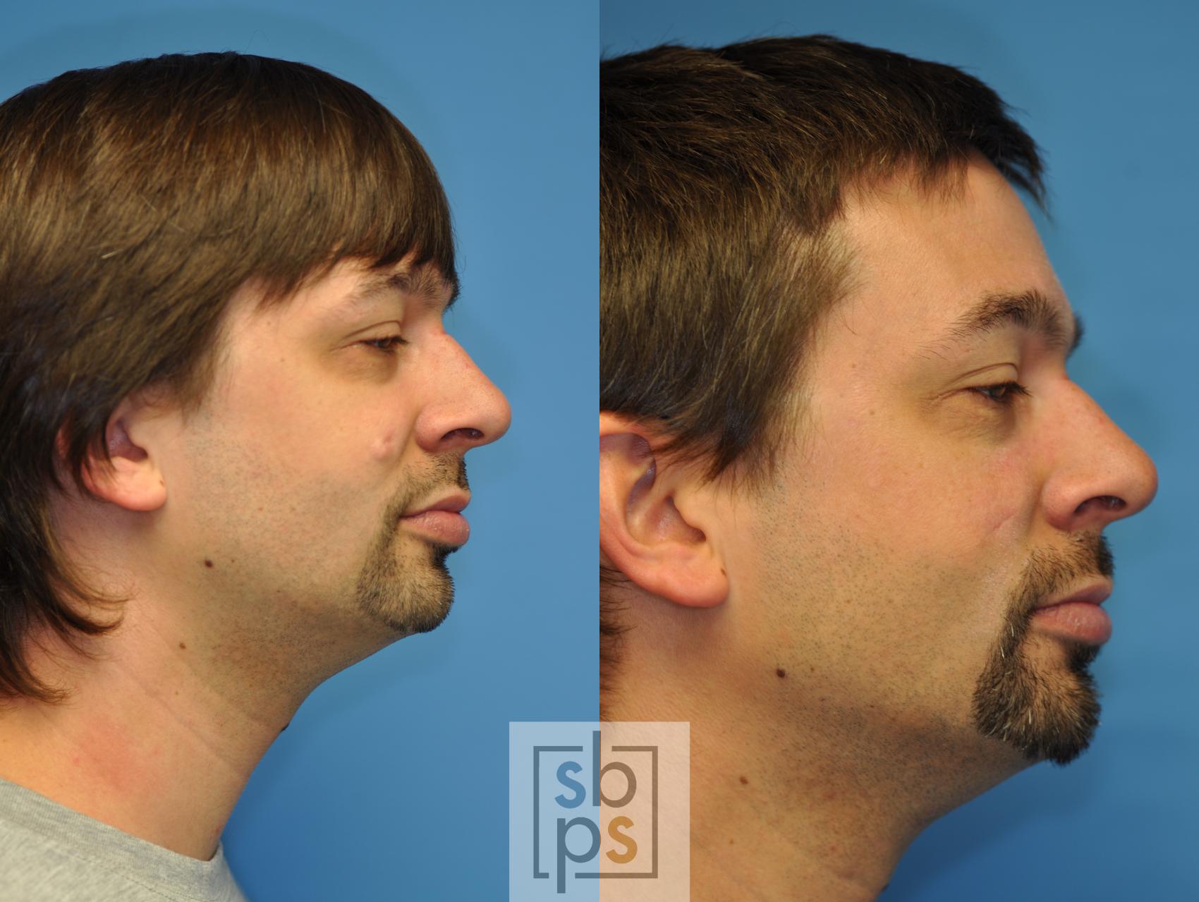 Before & After Lipoma & Mole Removal Case 120 View #2 View in Torrance & Los Angeles, CA, CA