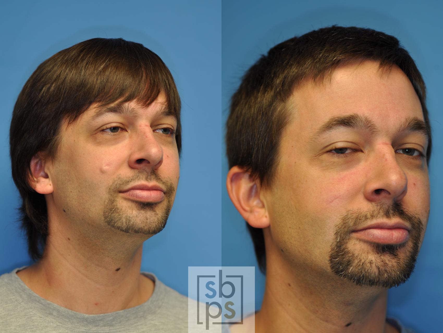 Before & After Lipoma & Mole Removal Case 120 View #3 View in Torrance & Los Angeles, CA, CA