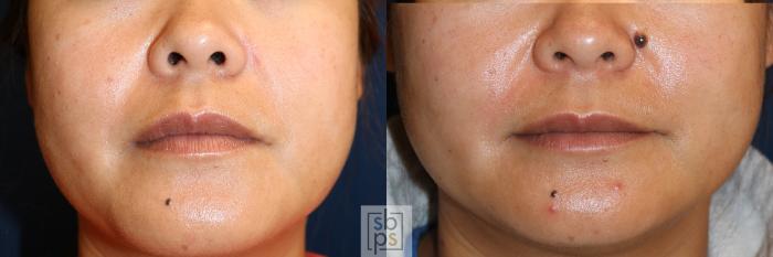 Before & After Lipoma & Mole Removal Case 613 Front View in Torrance, CA