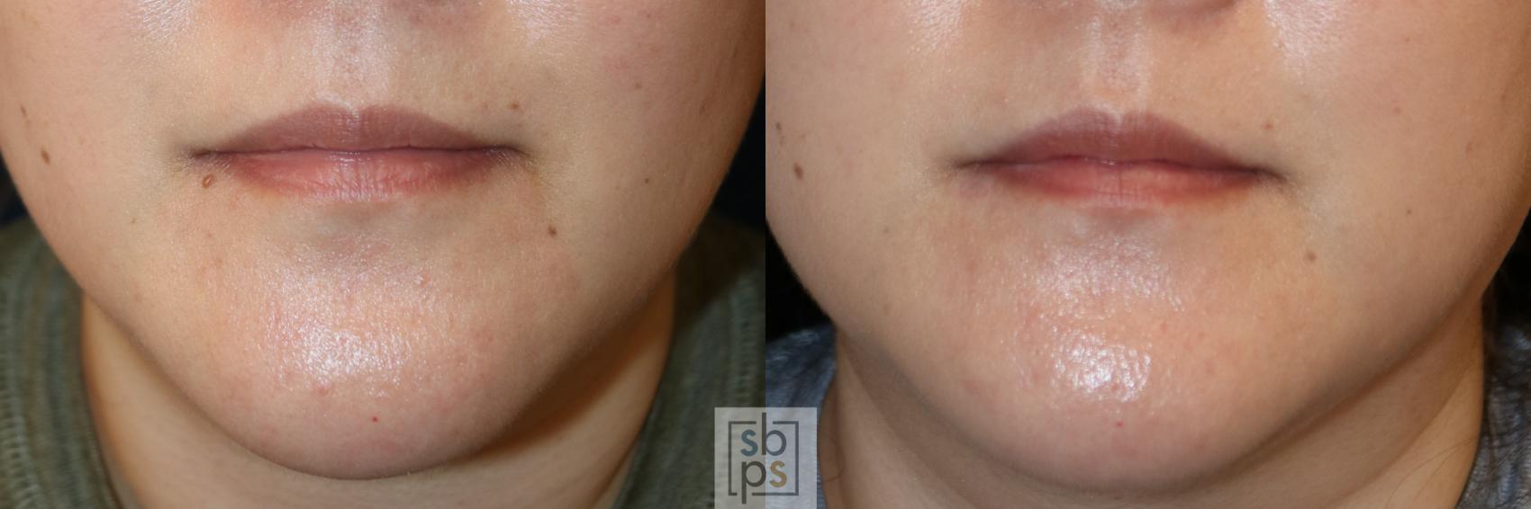 Before & After Lipoma & Mole Removal Case 745 Front View in Los Angeles, Torrance & Long Beach, CA