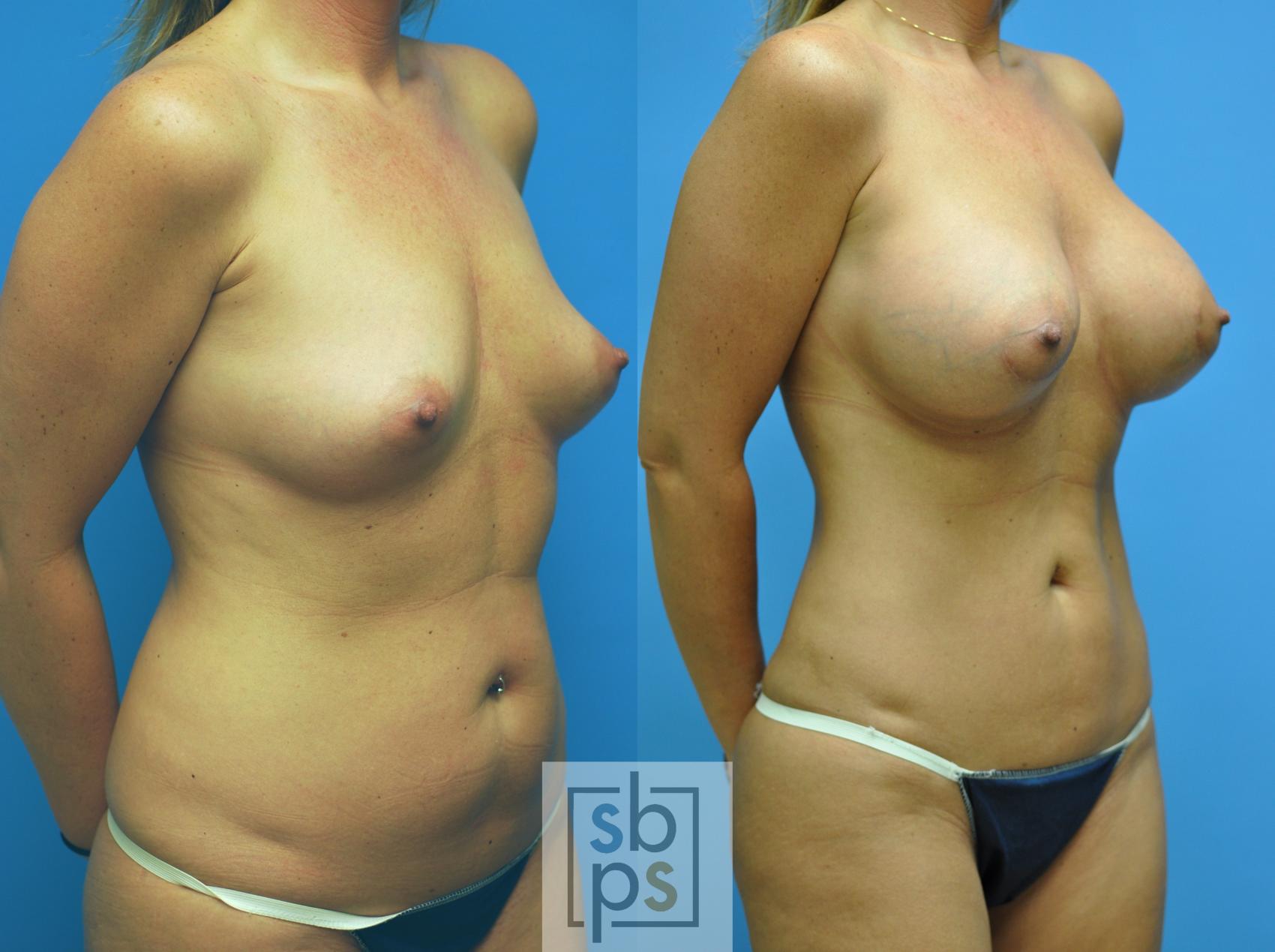 Before & After Liposuction Case 101 View #1 View in Torrance, CA