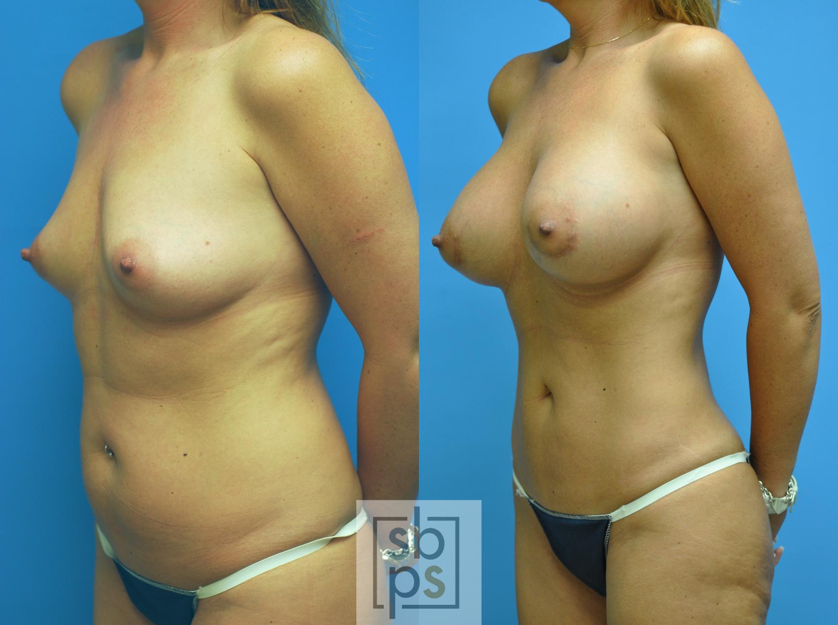 Before & After Liposuction Case 101 View #2 View in Torrance, CA