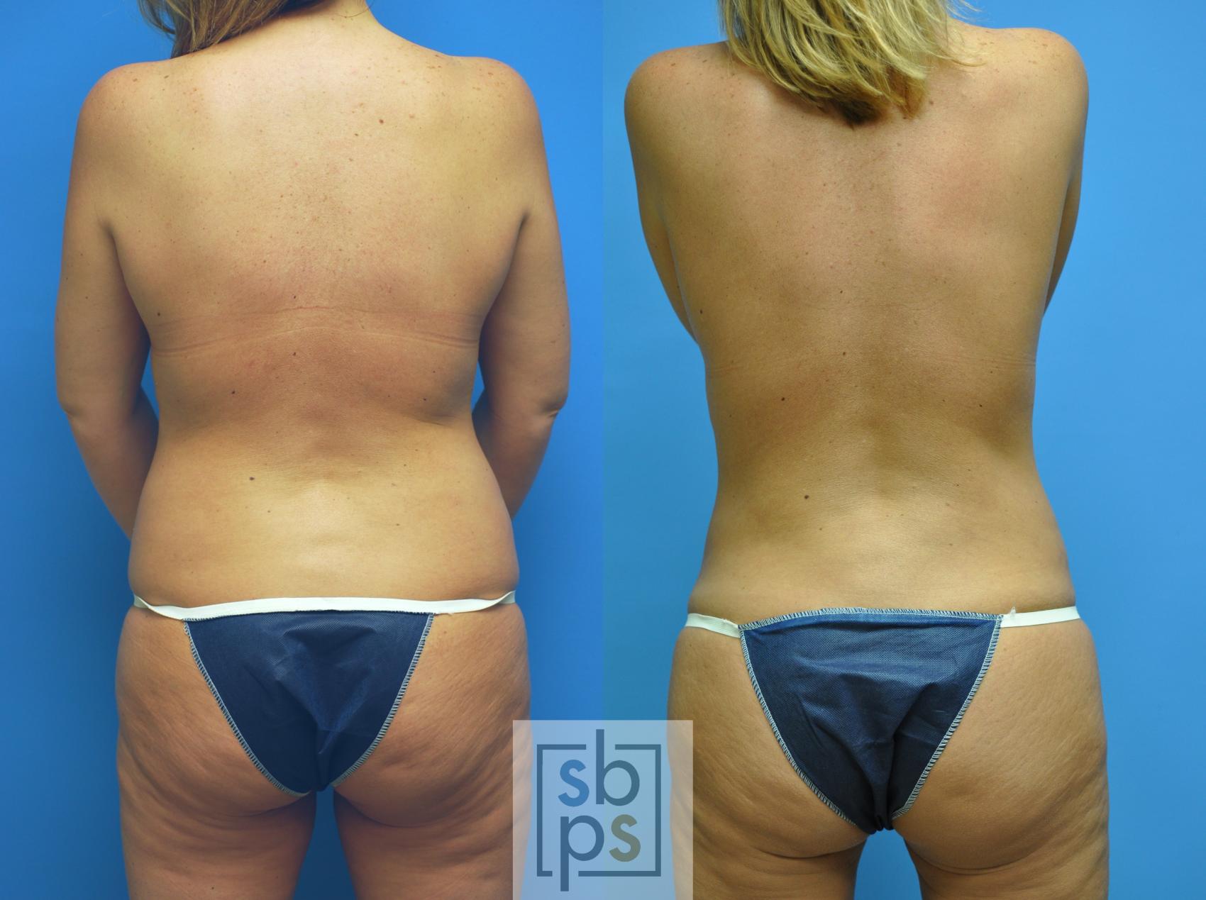 Before & After Liposuction Case 101 View #3 View in Torrance, CA