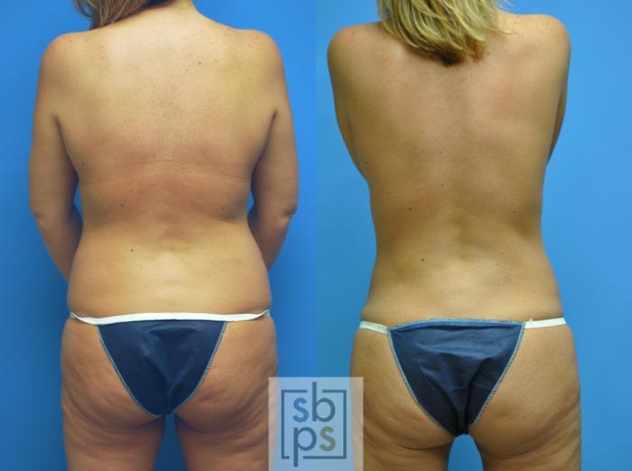 Before & After Breast Augmentation Case 101 View #3 View in Torrance, CA