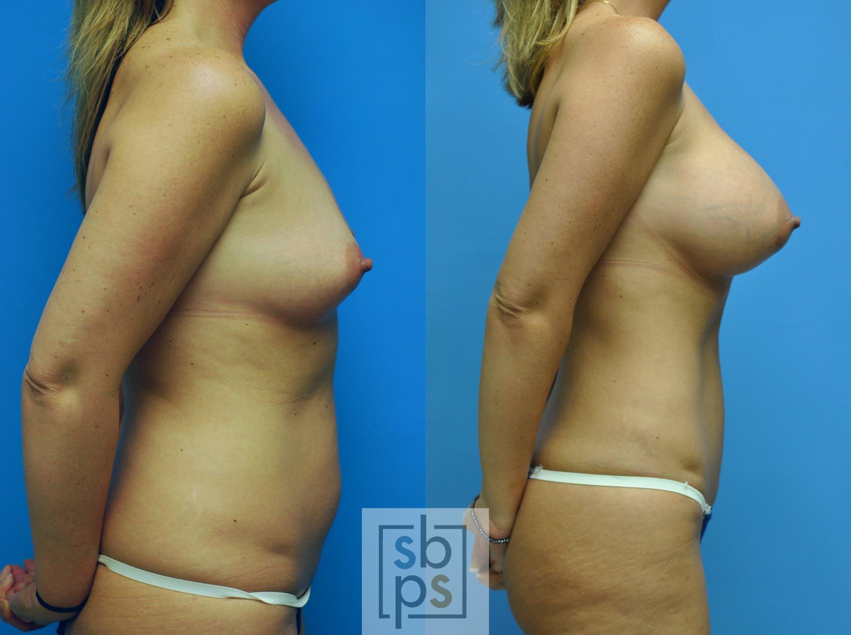 Before & After Liposuction Case 101 View #4 View in Torrance, CA