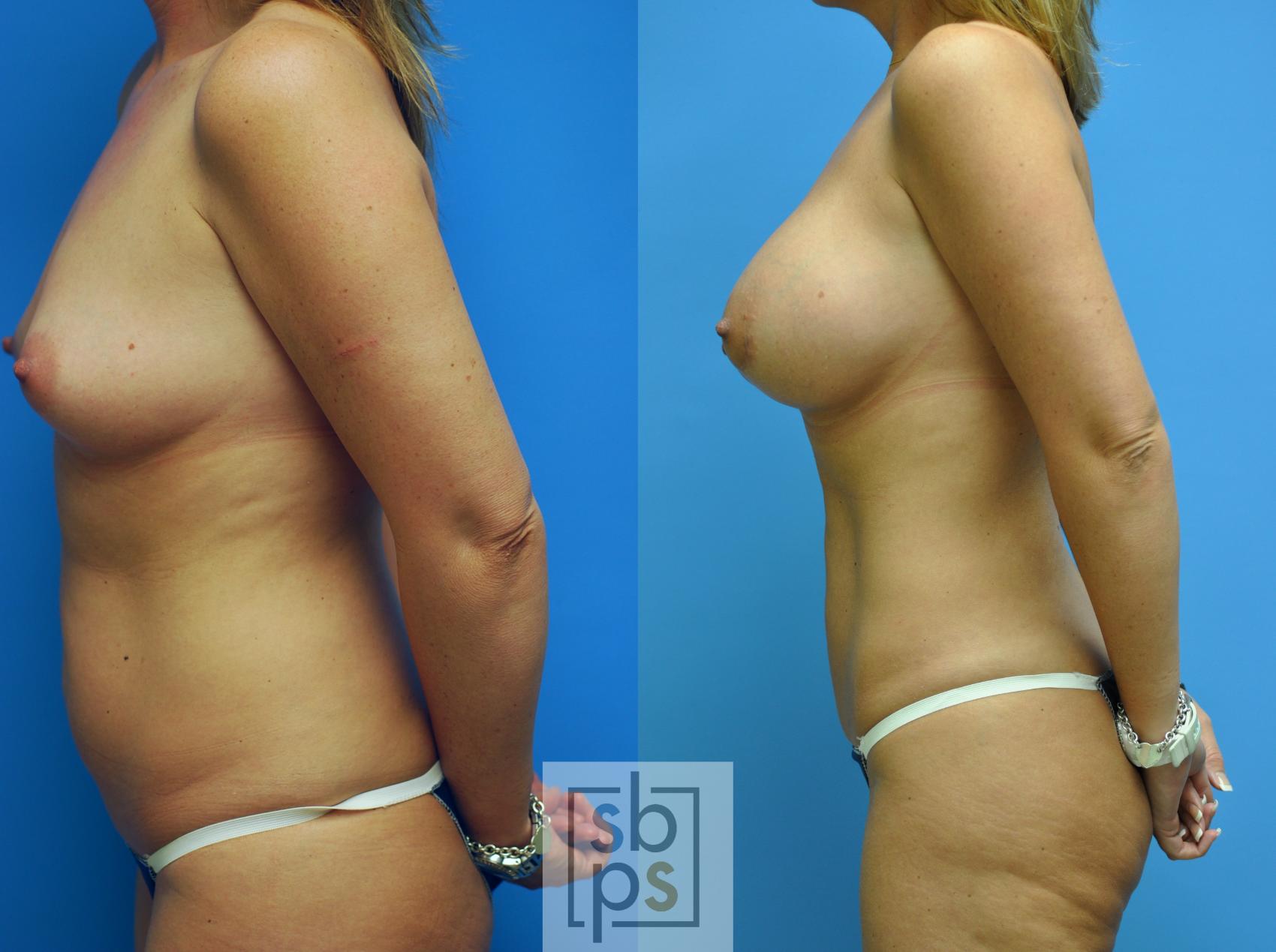 Before & After Liposuction Case 101 View #5 View in Torrance, CA