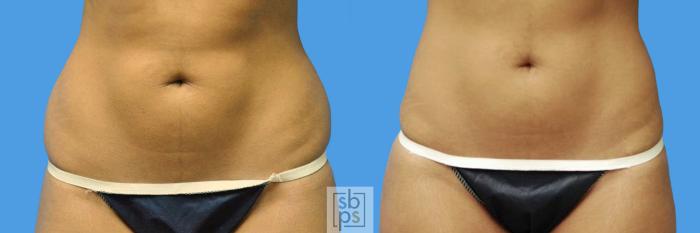 Before & After Liposuction Case 106 View #3 View in Torrance, CA