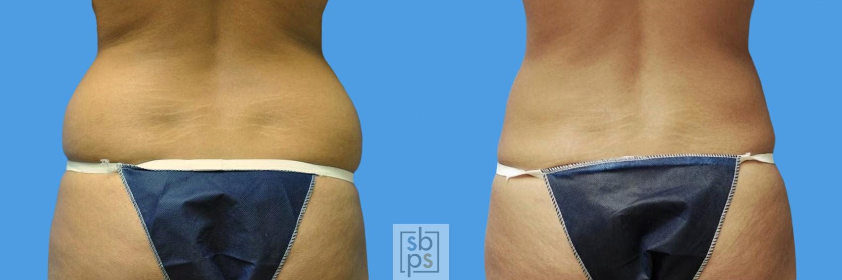 Before & After Liposuction Case 106 View #4 View in Torrance, CA