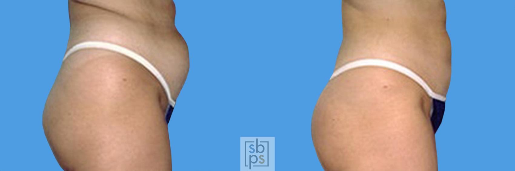 Before & After Liposuction Case 13 View #1 View in Torrance, CA
