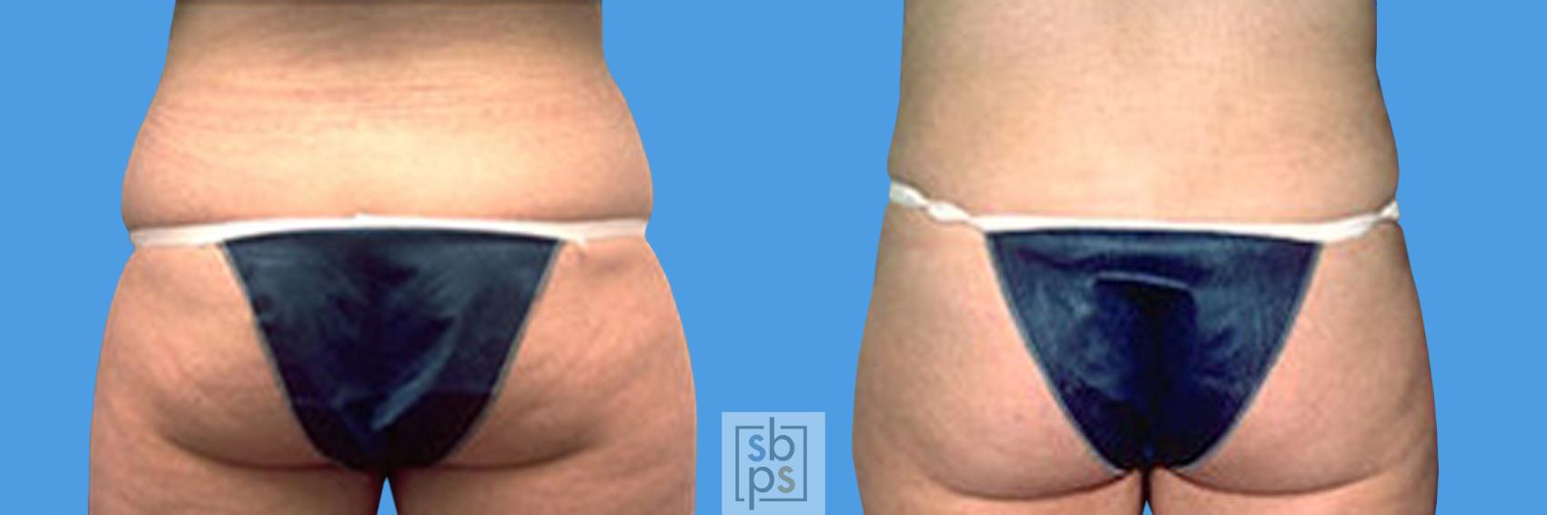 Before & After Liposuction Case 13 View #2 View in Torrance, CA