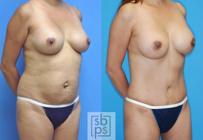 Before & After Tummy Tuck Case 136 View #1 View in Torrance, CA