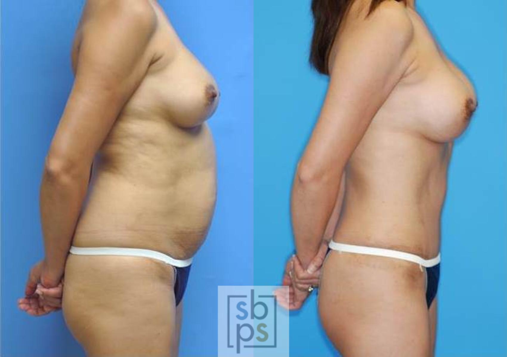 Before & After Liposuction Case 136 View #2 View in Torrance, CA