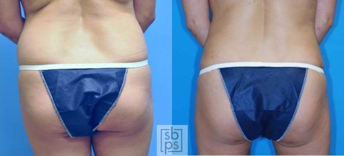 Before & After Liposuction Case 136 View #4 View in Torrance, CA