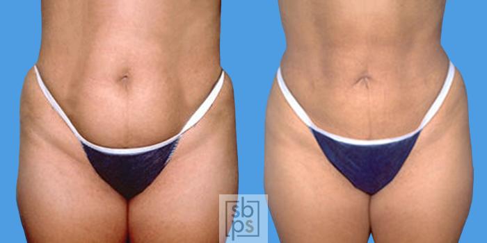 Before & After Liposuction Case 14 View #3 View in Torrance, CA
