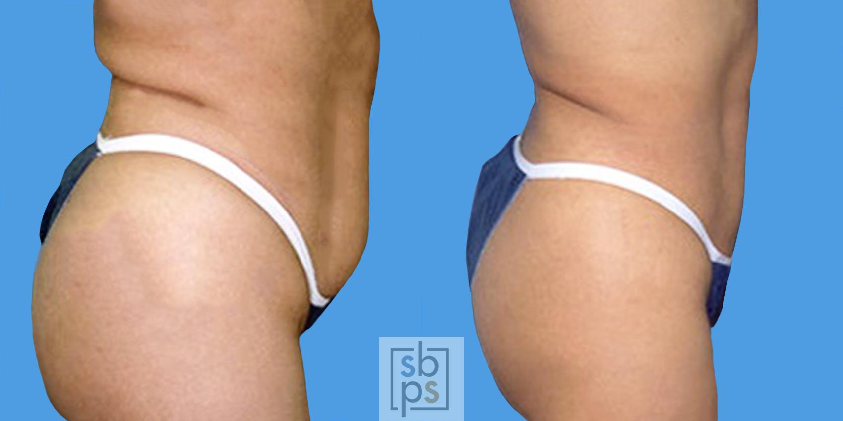 Before & After Liposuction Case 14 View #4 View in Torrance & Los Angeles, CA, CA