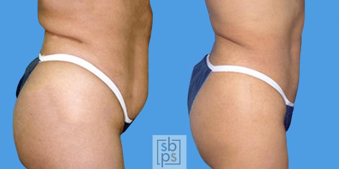 Before & After Liposuction Case 14 View #4 View in Torrance, CA