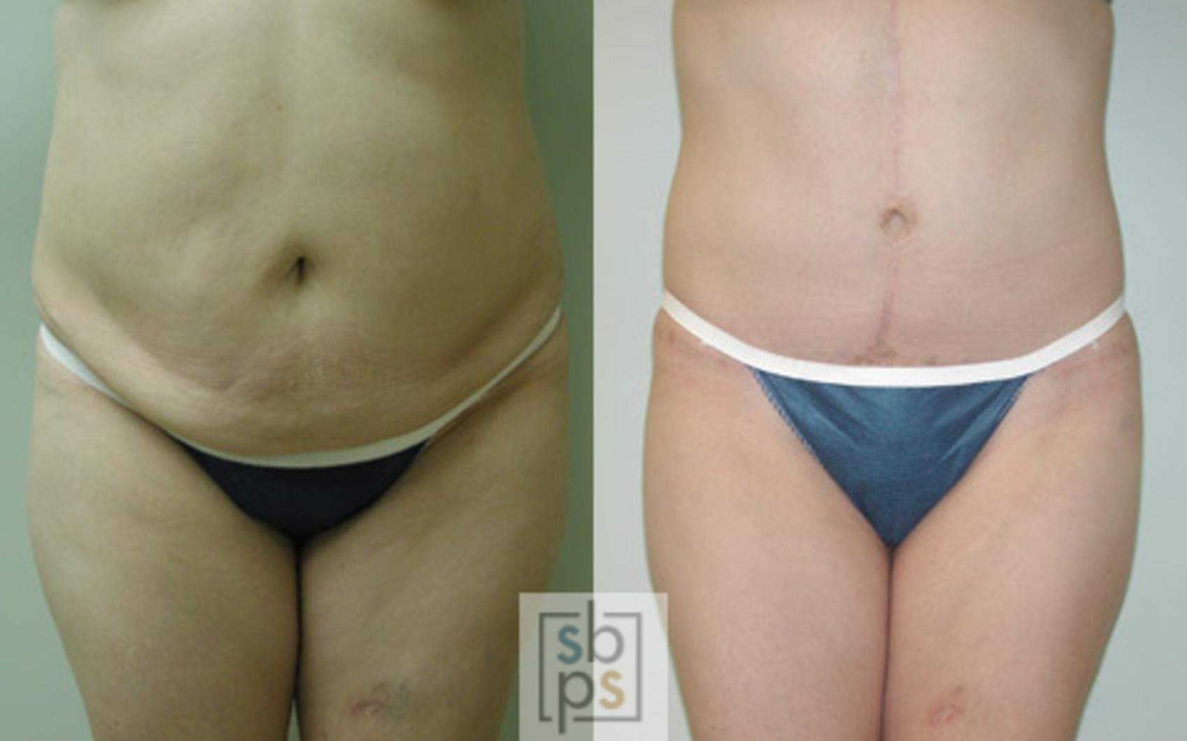 Before & After Liposuction Case 15 View #1 View in Torrance, CA