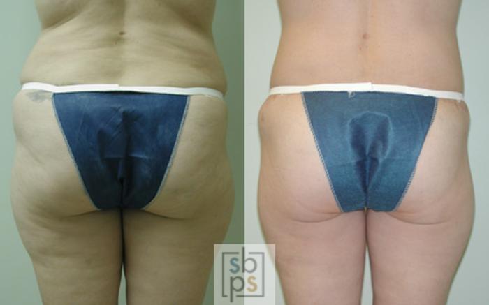 Before & After Tummy Tuck Case 15 View #2 View in Torrance, CA