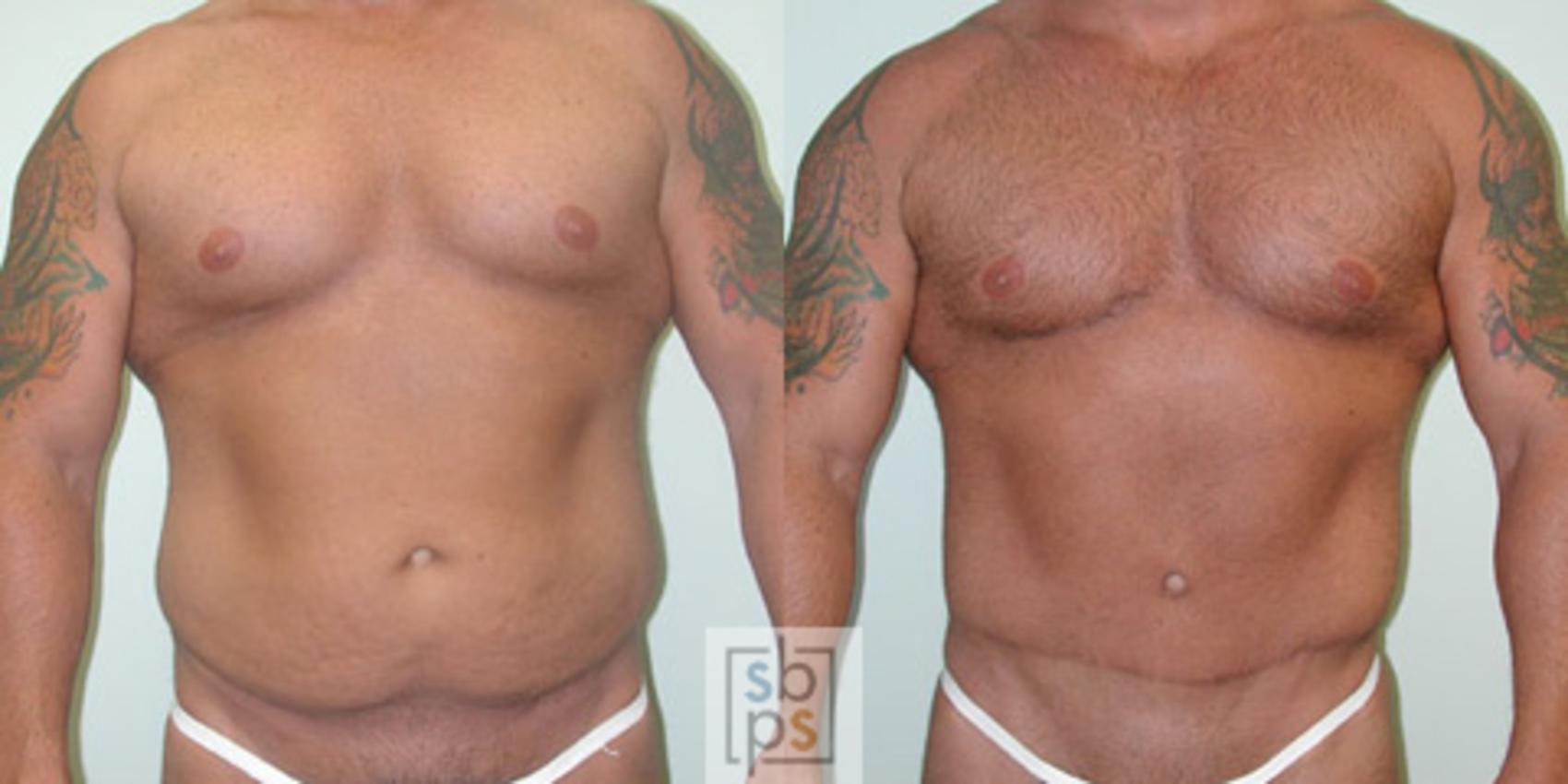 Before & After Liposuction Case 17 View #1 View in Torrance, CA