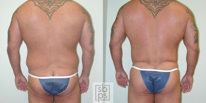 Before & After Liposuction Case 17 View #2 View in Torrance, CA